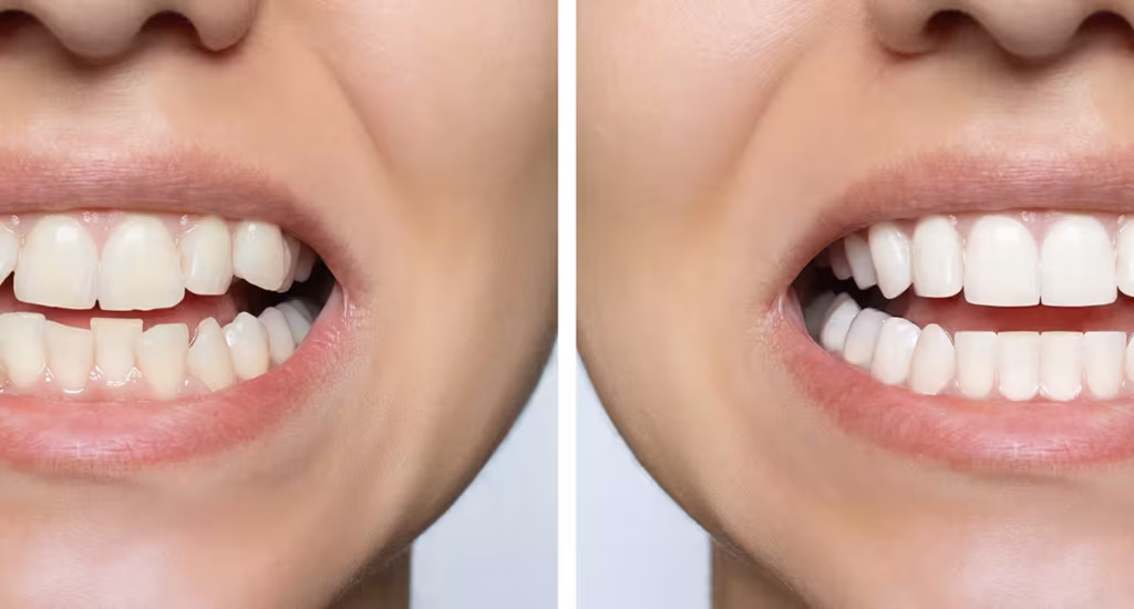 Resultado do tratamento com Invisalign: sorriso alinhado antes e depois — dentista Invisalign em Porto Alegre