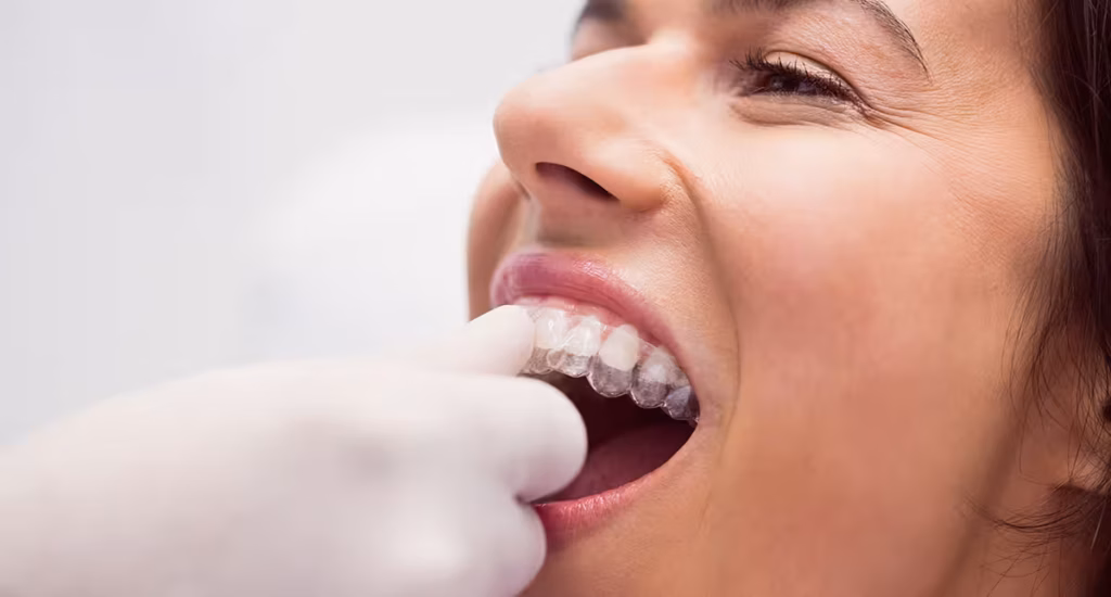 Paciente adulto usando alinhador Invisalign transparente durante tratamento ortodôntico