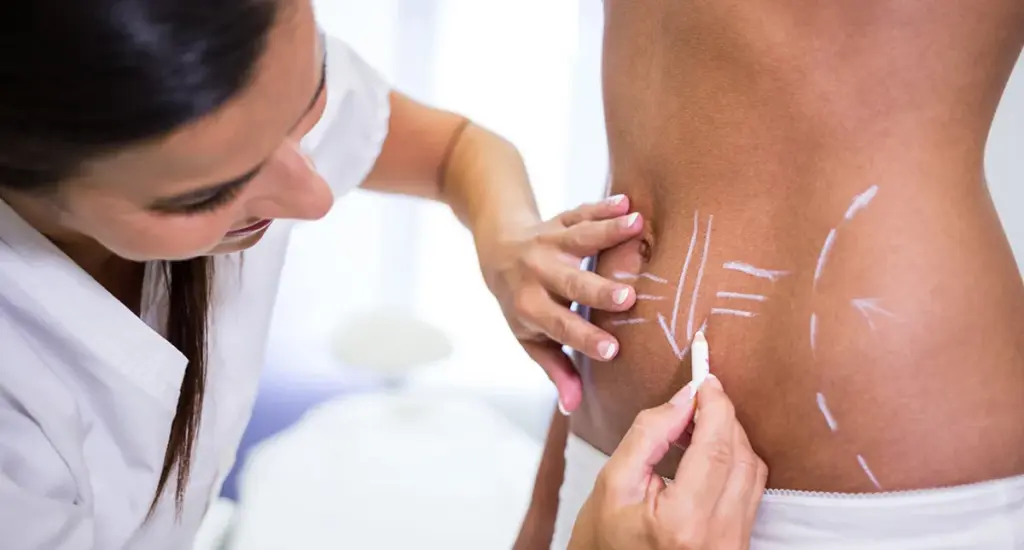 Comparação entre abdominoplastia tradicional e miniabdominoplastia
