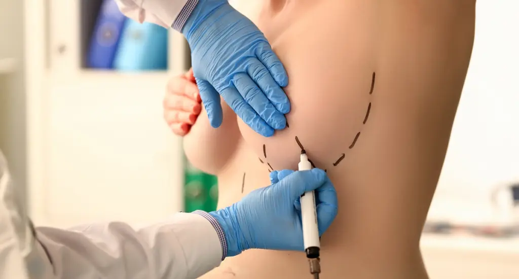 Marcação cirúrgica para procedimento de mastopexia