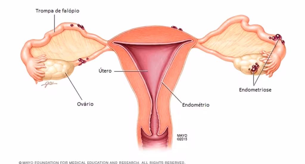 ilustração do útero com tecido endometrial fora da cavidade, explicando o que é endometriose