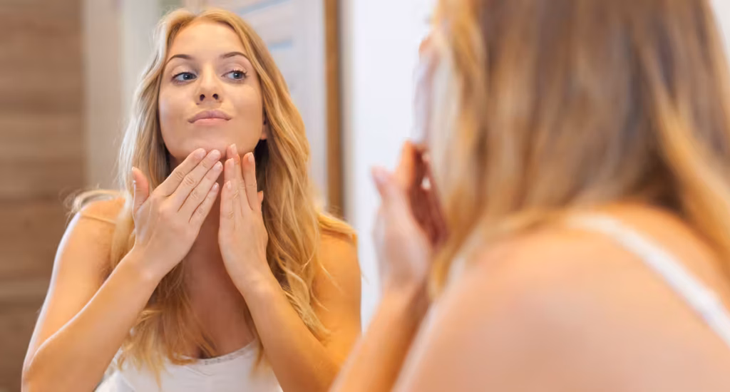 mulher com acne hormonal no queixo e mandíbula, sintoma de SOP