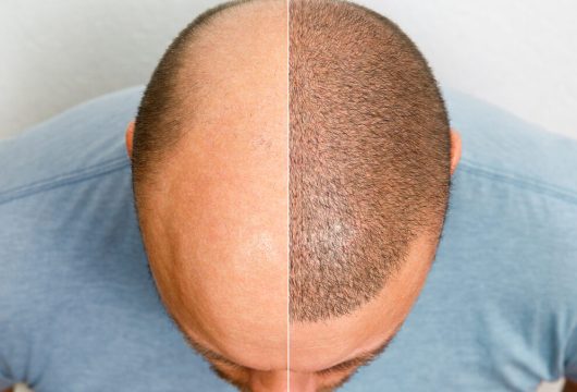 The head of a balding man before and after hair transplant surgery. A man losing his hair has become shaggy. An advertising poster for a hair transplant clinic. Treatment of baldness