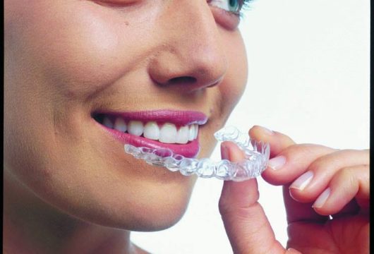 34725af2-9c4b-4383-93f6-5466869d78f0_Invisalign