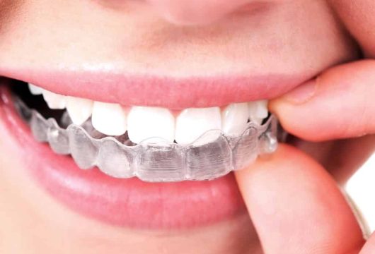 648bc2913fc10163458c871c_invisalign-25
