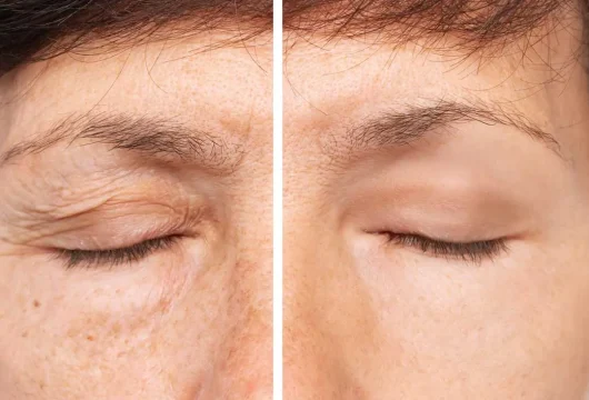blefaroplastia