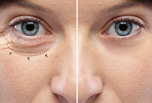 img_blefaroplastia-2